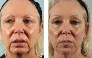 Skinfluence Facial Rejuvenation