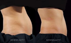 Spider Vein Removal Upper East Side