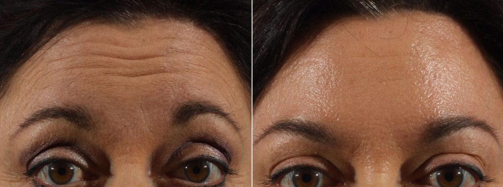 Neurotoxin Transformation Case 4