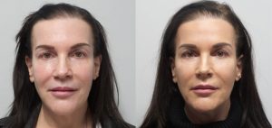 Skinfluence Facial Rejuvenation