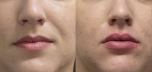 Filler Transformation