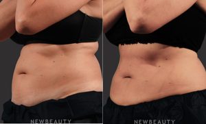 Skinfluence Body Treatments