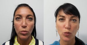 Filler Transformation