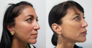 Skinfluence Filler Transformation