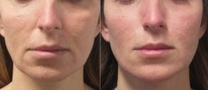 Skinfluence Acne Transformation
