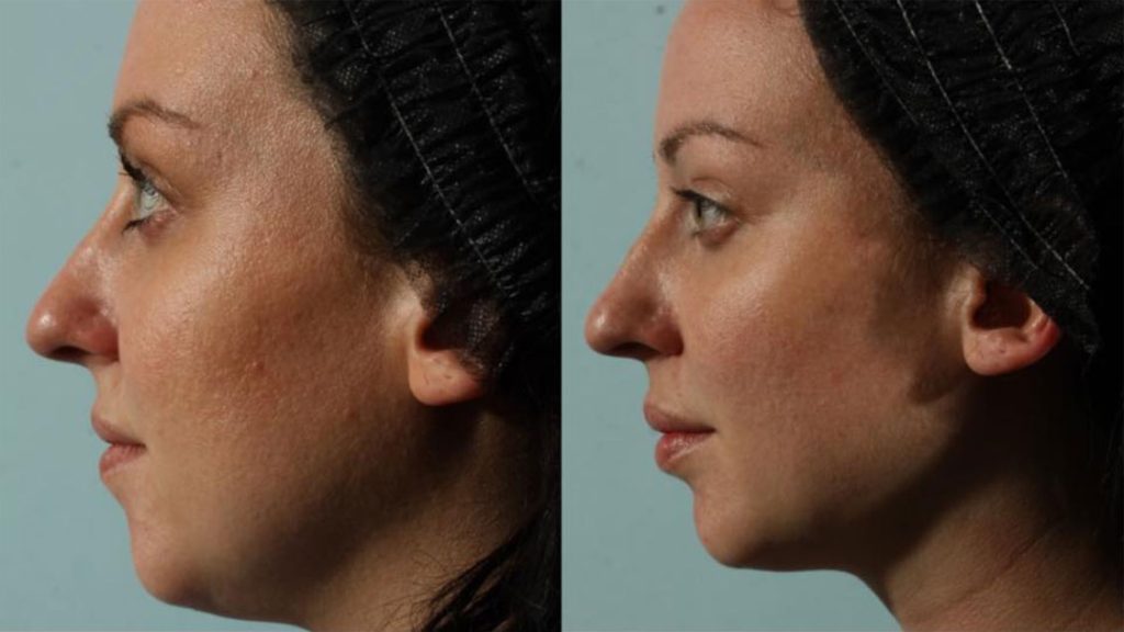 Facial Rejuvenation Case 3