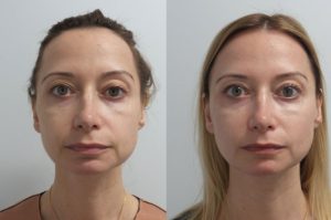 Filler Transformation