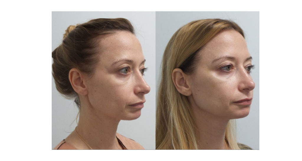 Filler transformation Case 10