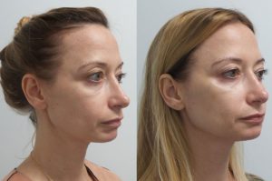 Filler Transformation