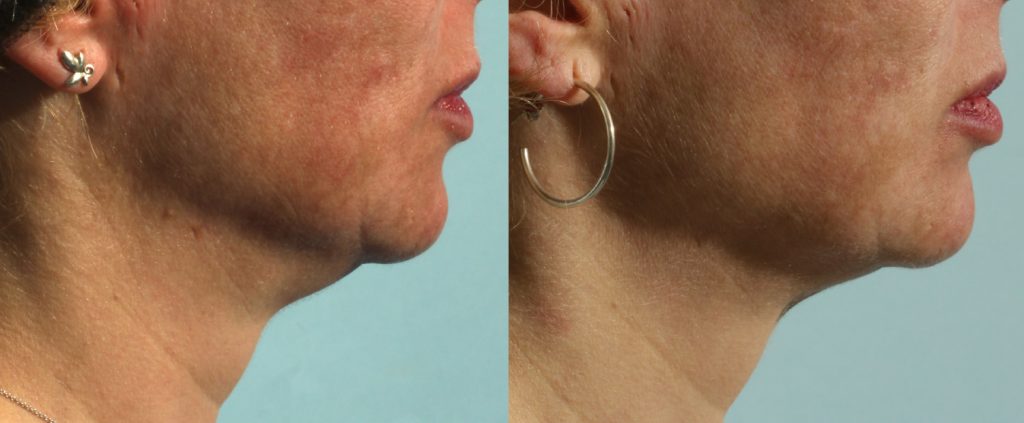 Facial Rejuventation Case 1