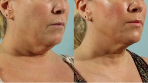 Skinfluence Body Treatments