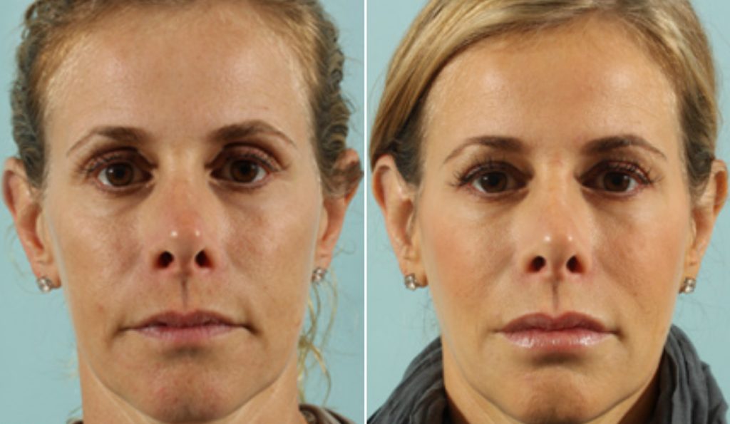 Filler Transformation Case 2