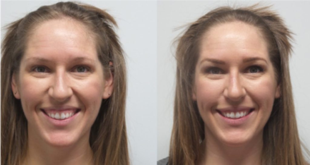 Neurotoxin Transformation Case 5