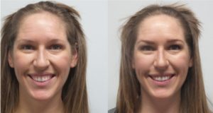 Neurotoxin Transformation