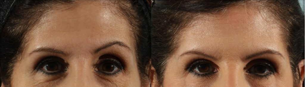 Neurotoxin Transformation Case 6