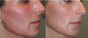 Skinfluence Acne Transformation