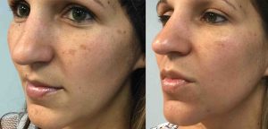 Skinfluence Laser Transformation