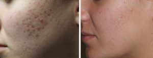 Skinfluence Acne Transformation