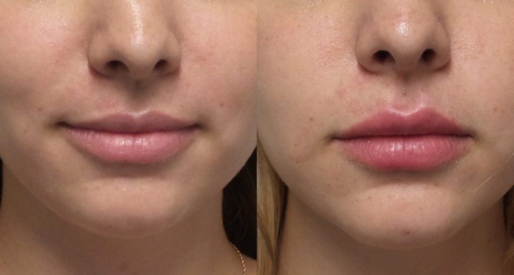 Filler Transformation Case 9