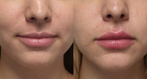 Filler Transformation