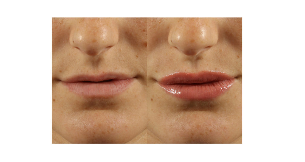 Filler Transformation Case 7