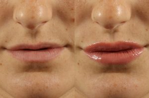 Filler Transformation