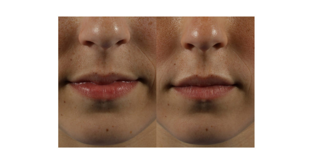 Filler Transformation Case 6