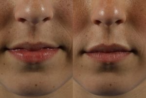 Filler Transformation