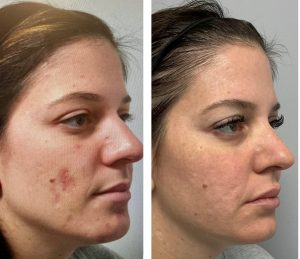 Skinfluence Acne Transformation