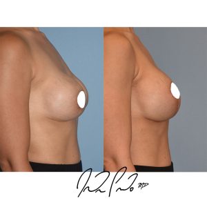 Breast Lift with Augmentation