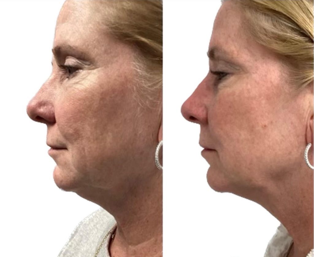 Facial Rejuvenation Case 8