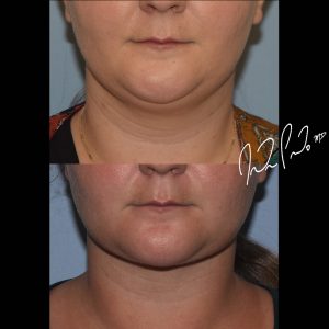 Neck Liposuction
