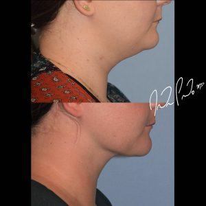 Neck Liposuction