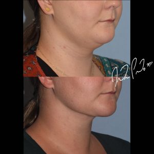 Neck Liposuction