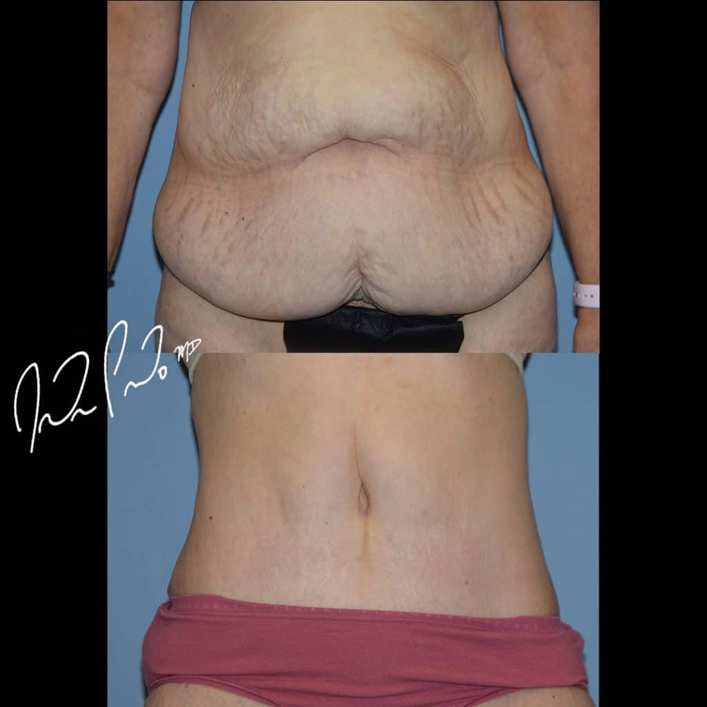 Abdominoplasty Case 1