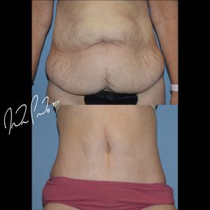 Abdominoplasty