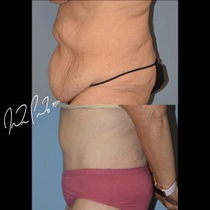Abdominoplasty