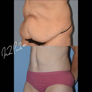 Abdominoplasty