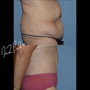 Abdominoplasty