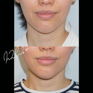 Neck Liposuction with Accutite