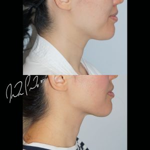 Neck Liposuction with Accutite