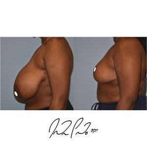 Breast Reduction