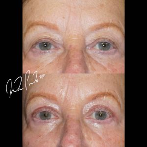 Blepharoplasty