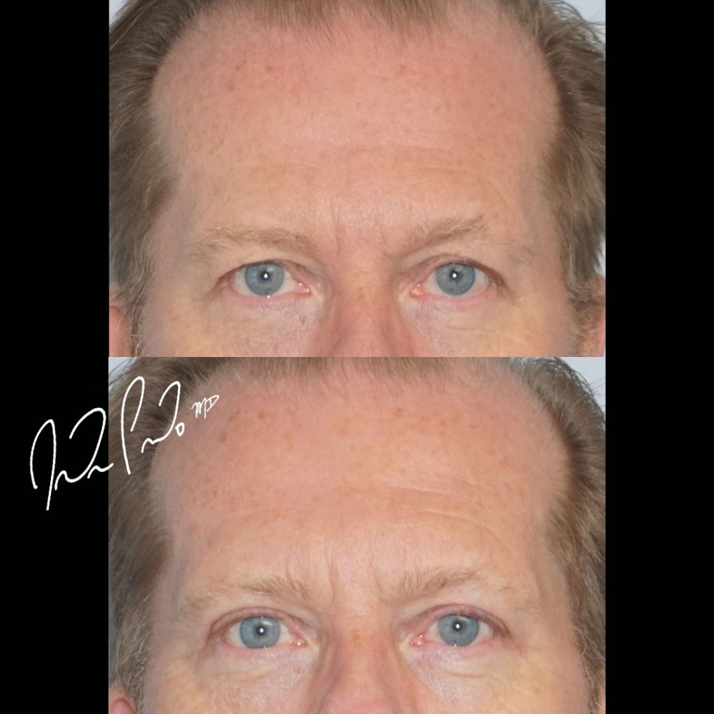 Blepharoplasty Case 2