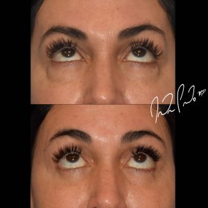 Blepharoplasty