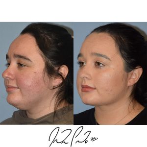 Neck Liposuction
