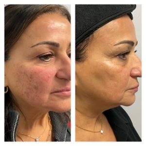 Skinfluence Facial Rejuvenation