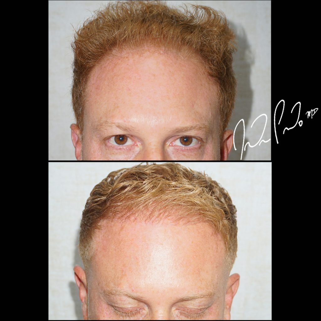 Hair Transplant Case 1