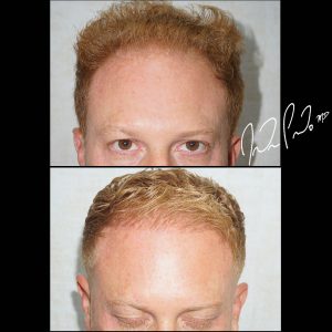 Hair Transplant
