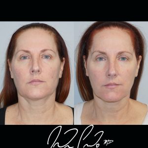 Neck Liposuction with Accutite
